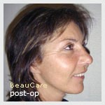 Photo lifting visage après opération