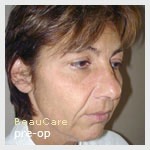 Photo lifting visage avant opération